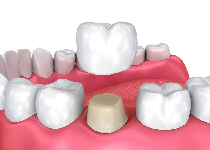 Dental Crowns